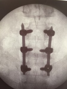 Artrodesis Lumbar