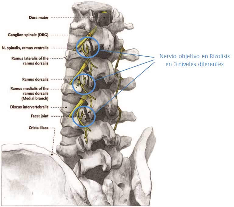 Nervios-objetivo-rizolisis-en-3-niveles